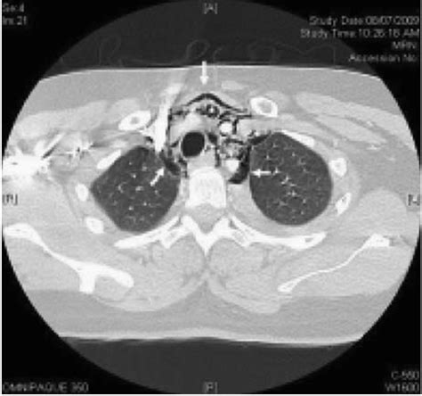Computed Tomography Thorax Showing Extensive Pneumomediastinum Arrows