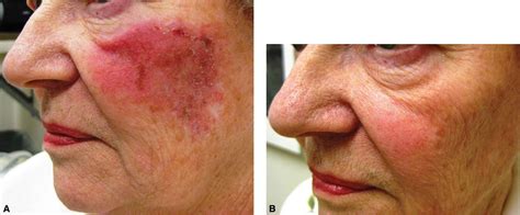 Fluorouracil As Related To Skin Cancer Pictures