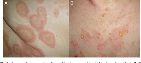 Figure 1 From Bullous Pemphigoid Clinical Practice Guidelines