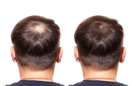 What Causes Hair Loss In The Crown Of Your Head