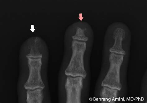 Acro Osteolysis