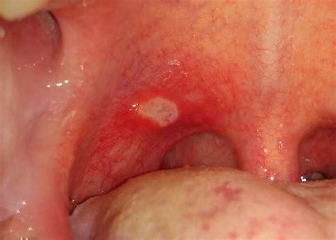 Aphthous Ulcers Treatment Pictures Causes Types Symptoms