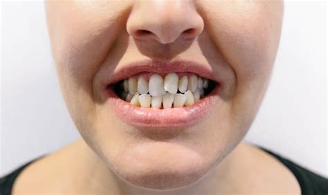 Apiñamiento Dental Corrige Los Dientes Montados Clemente Dental