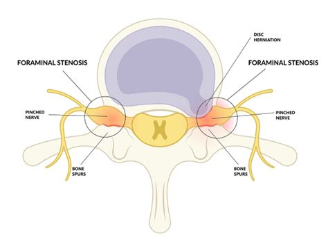 Bilateral Foraminal Stenosis Causes Symptoms And Treatment