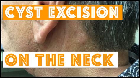 Cyst Excision On The Neck Youtube