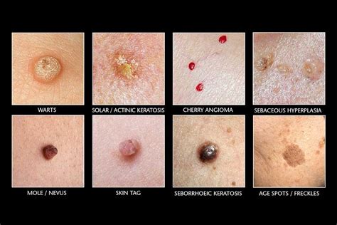 Recolectar 120 Images Skin Tag And Mole Removal Viaterramx