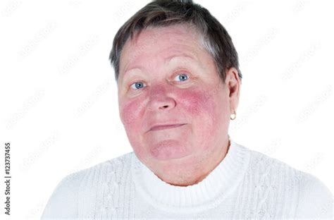 Rosacea Facial Skin Disorder Portrait Of Unhappy Elderly Woman Stock