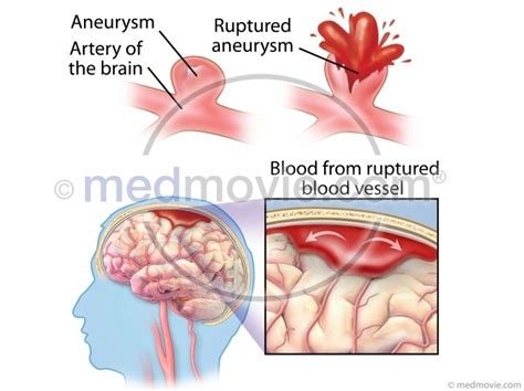 Hemorrhagic Stroke And Ruptured Aneurysm
