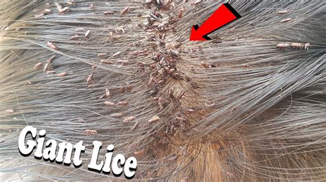 Piking Out Million Giant Lice From Girls Head Lice Combing Youtube