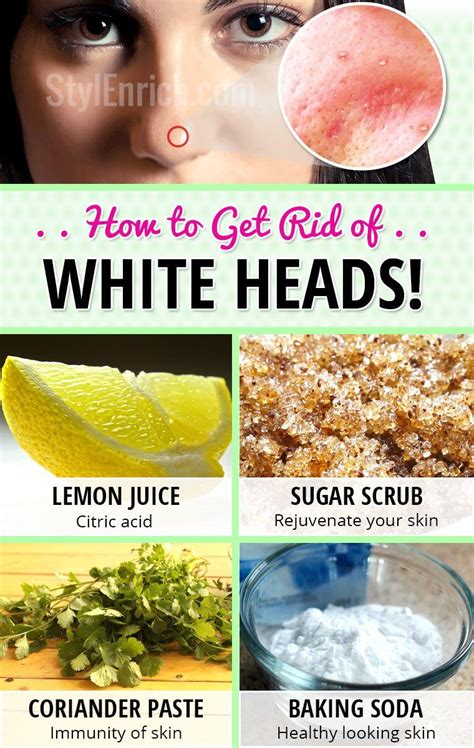 How To Get Rid Of Whiteheads On Face Using Home Remedies Whiteheads