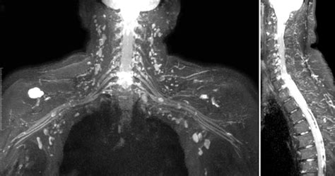 Mr Neurography Of Brachial Plexus At 30 T With Robust Fat And Blood