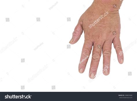 Male Palms Eczema Isolated On White Stock Photo 298829408 Shutterstock