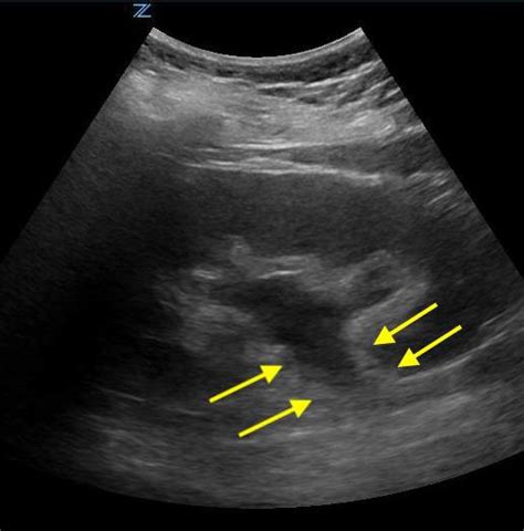 Extrarenal Pelvis Ultrasound