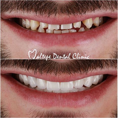 This Patient Visited Maltepe Dental Clinic Istanbul Turkey From