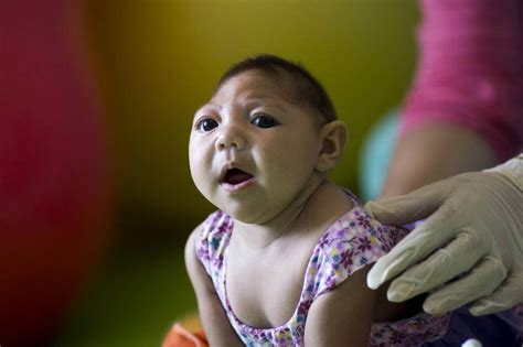 Delayed Onset Damage From Zika Can Appear Up To A Year After Birth