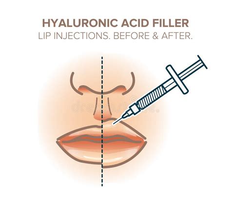 Lip Injections Before And After Hyaluronic Acid Filler Stock Vector