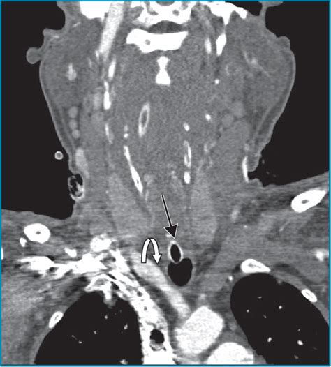 Figure From Life Threatening Tracheostomy Site Bleeding From Granulation Tissue Mimicking