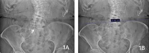 Cureus Using Lumbar X Ray To Facilitate Modified Taylors Approach Of