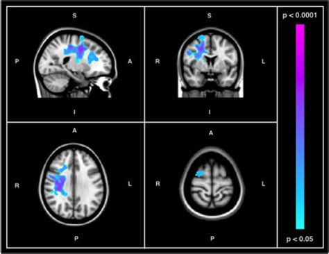 Frontiers Resting State Bold Variability In Alzheimers Disease A