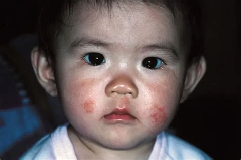 Atopic Dermatitis Image Pictures Photos