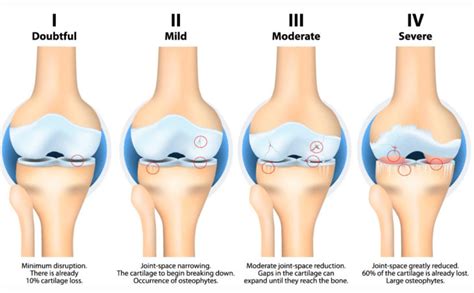 Knee Pain And Osteoarthritis Of The Knee Inevitable In The Elderly