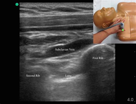 Playultrasound Guided Subclavian Line Emory School Of Medicine