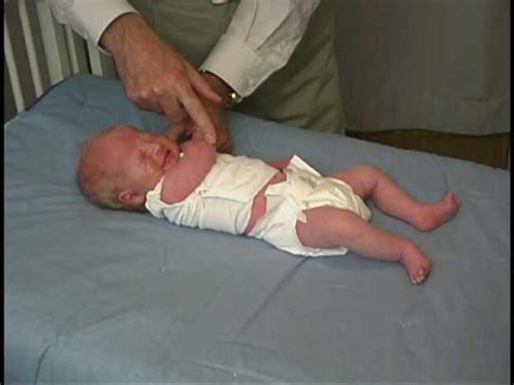 Neurologic Exam Pediatric Newborn Abnormal Tone Scarf Sign