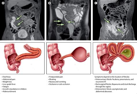 Crohn S Disease The Lancet