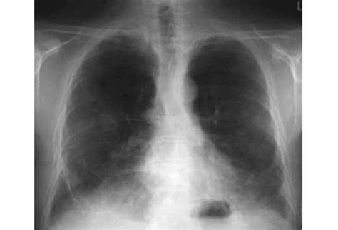 Occupational Lung Diseases Slideshow