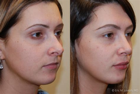 Eric M Joseph Md Lip Augmentation Before And After Increased Upper