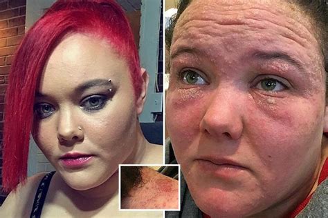 Mum Scarred By Horrific Allergic Reaction To Hair Dye Which Was