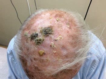 A number of treatments are available for actinic keratosis, a condition in which too much sun exposure leads to lesions (keratoses) that may become cancerous. Actinic Keratoses (precancers) Treatments - Lakeview ...
