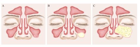 Are Mucous Retention Cysts And Pseudocysts In The Maxillary Sinus A