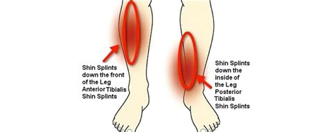 Knee Pain Radiating Down Shin Hot Deals Save 46 Jlcatjgobmx
