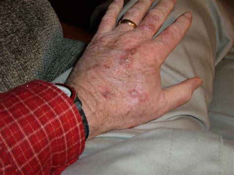 Skin Cancer Hands Images