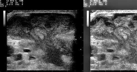 Nevits Blog Ultrasound Image Of Breast Abscess Original Version And