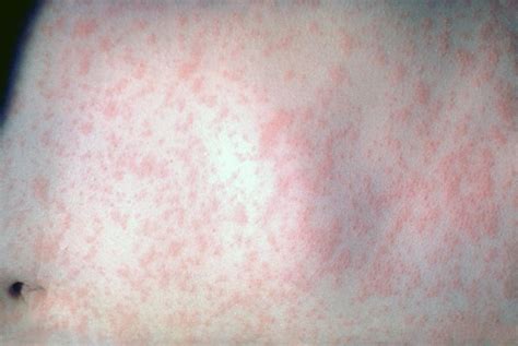 Viral Rash Types Symptoms And Treatment In Adults And Babies