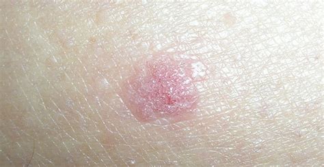 Skin Cancer Types Symptoms Melanoma And Treatment