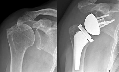 Reverse Shoulder Arthroplasty For Massive Irreparable Rotator Cuff Tears A Reliable Treatment