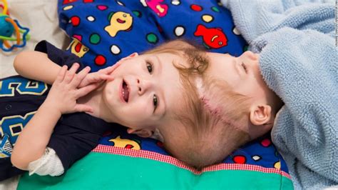 Twins Born With Conjoined Heads Finally Got Separated After 27 Hours Of