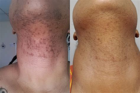 Laser Hair Removal Before And After Dark Skin Haircut HairStyle