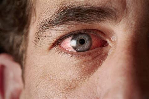 Focus On Eye Irritation Xcellr8