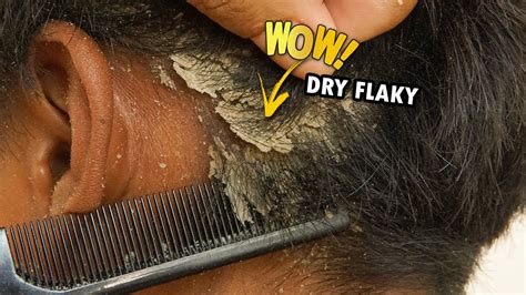 Scratching Dandruff Dry Flaky Scalp With A Black Comb 377 Youtube