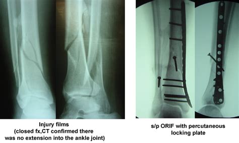 Tibial Shaft Fractures Trauma Orthobullets