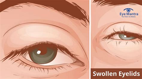 Swollen Eyelids Causes Symptoms Treatment Eyemantra
