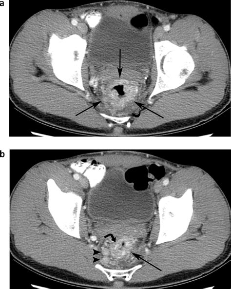 A Axial Image From Contrast Enhanced Ct Of The Abdomen And Pelvis At