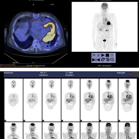the f 18 fdg whole body positron emission tomography scan reveals download scientific diagram