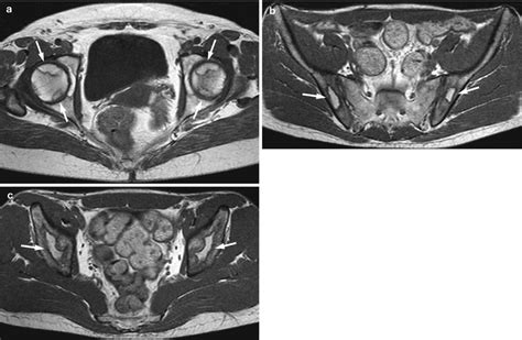 The Abnormal Bone Marrow Mri Patterns Radiology Key