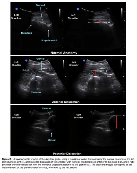 Msk Ultrasound For Shoulder Dislocation — Journalfeed