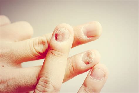 Nail Fungal Infection Causes Treatment And Symptoms